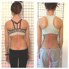 Improving Posture and Managing Scoliosis Pain at Holistic Leighis Spa Massage