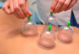 Deep Cupping massage